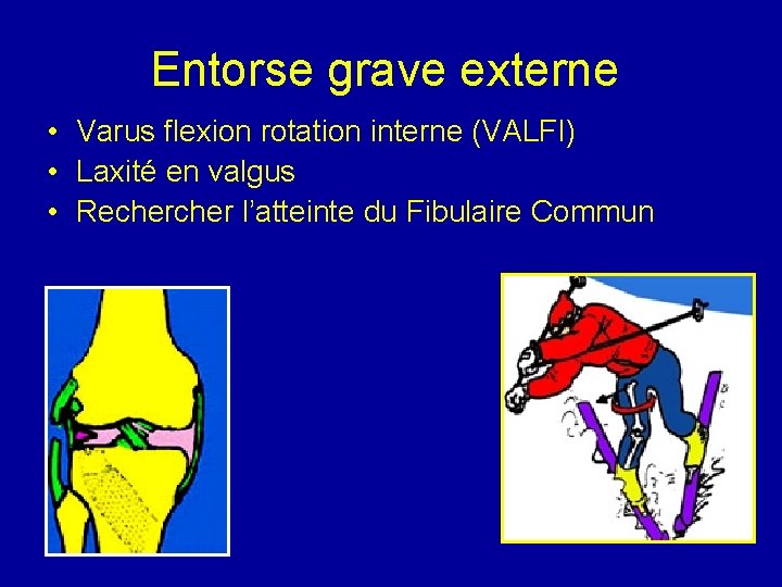 Entorse grave externe • Varus flexion rotation interne (VALFI) • Laxité en valgus •