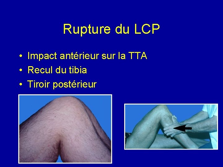 Rupture du LCP • • Impact antérieur sur la TTA Recul du tibia Tiroir