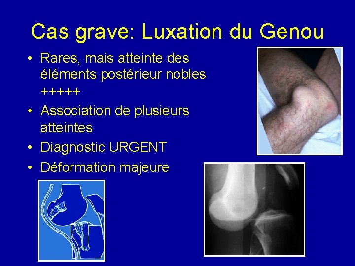 Cas grave: Luxation du Genou • Rares, mais atteinte des éléments postérieur nobles +++++