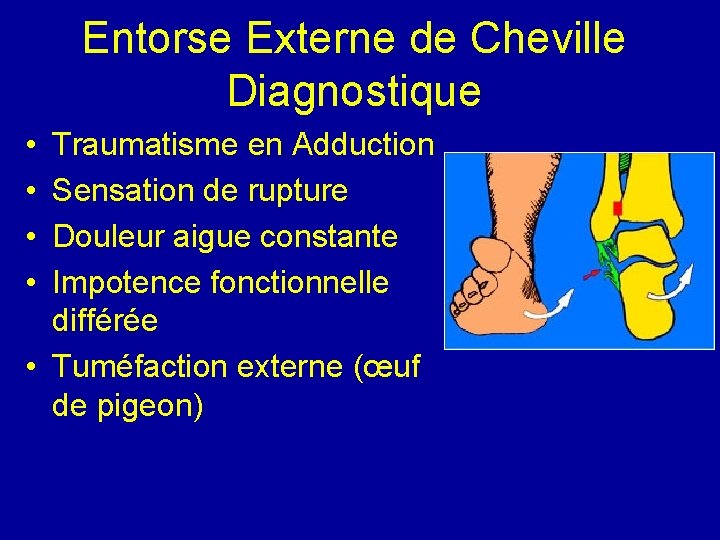 Entorse Externe de Cheville Diagnostique • • Traumatisme en Adduction Sensation de rupture Douleur