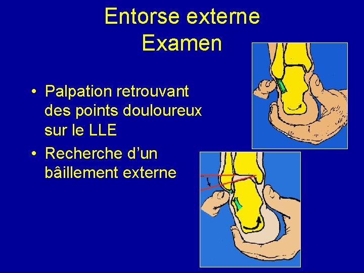 Entorse externe Examen • Palpation retrouvant des points douloureux sur le LLE • Recherche