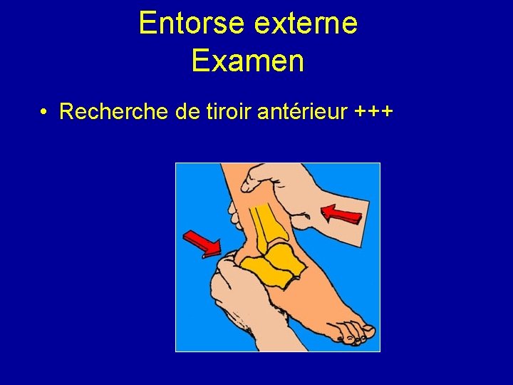 Entorse externe Examen • Recherche de tiroir antérieur +++ 