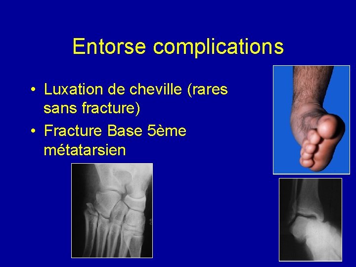 Entorse complications • Luxation de cheville (rares sans fracture) • Fracture Base 5ème métatarsien