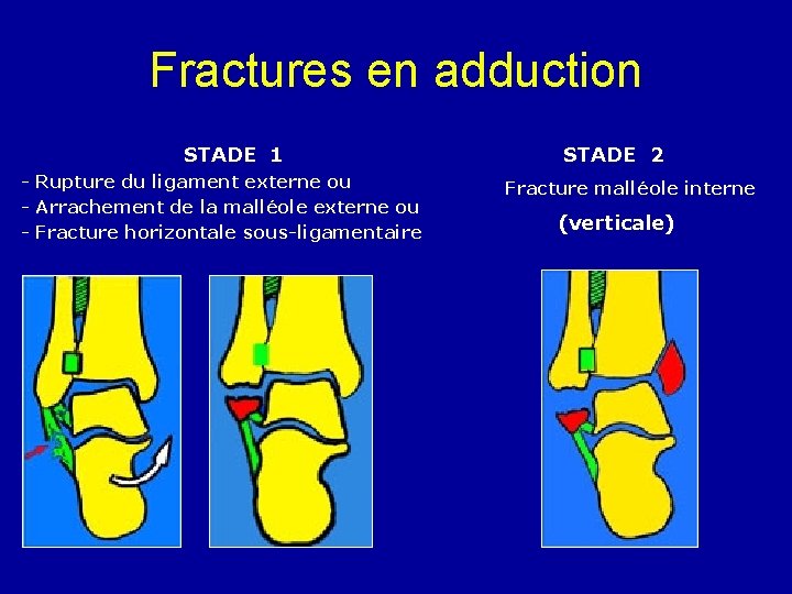 Fractures en adduction STADE 1 - Rupture du ligament externe ou - Arrachement de