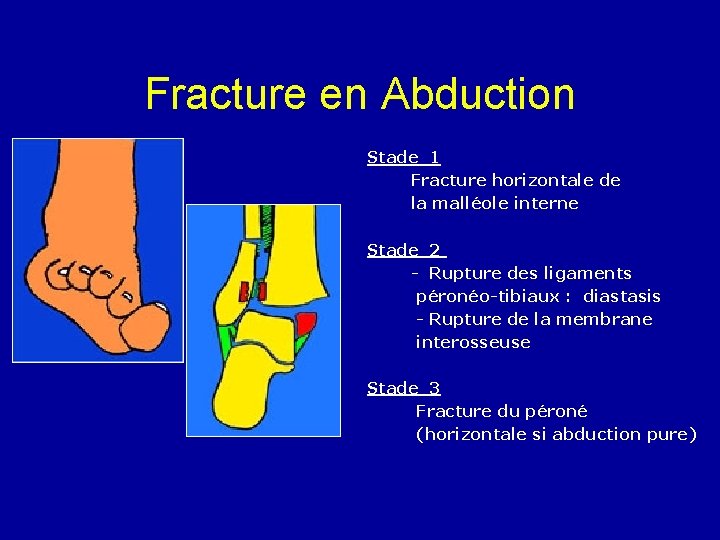 Fracture en Abduction Stade 1 Fracture horizontale de la malléole interne Stade 2 -