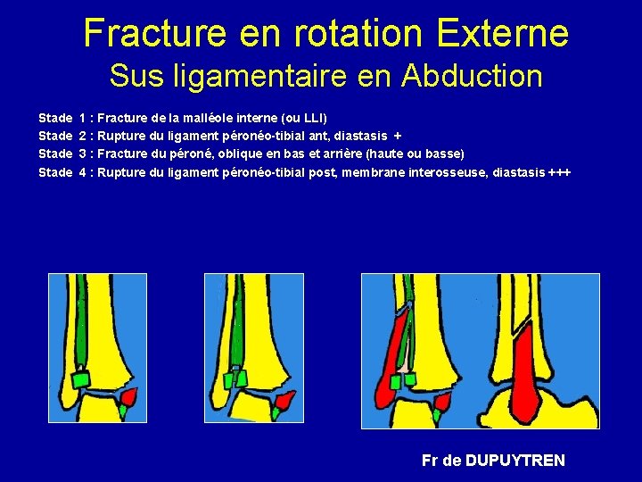 Fracture en rotation Externe Sus ligamentaire en Abduction Stade 1 : Fracture de la