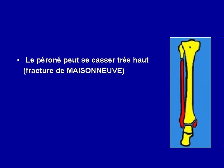  • Le péroné peut se casser très haut (fracture de MAISONNEUVE) 