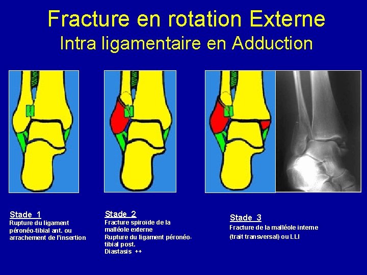 Fracture en rotation Externe Intra ligamentaire en Adduction Stade 1 Rupture du ligament péronéo-tibial