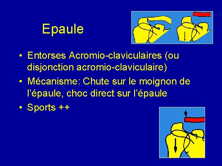 Epaule • Entorses Acromio-claviculaires (ou disjonction acromio-claviculaire) • Mécanisme: Chute sur le moignon de