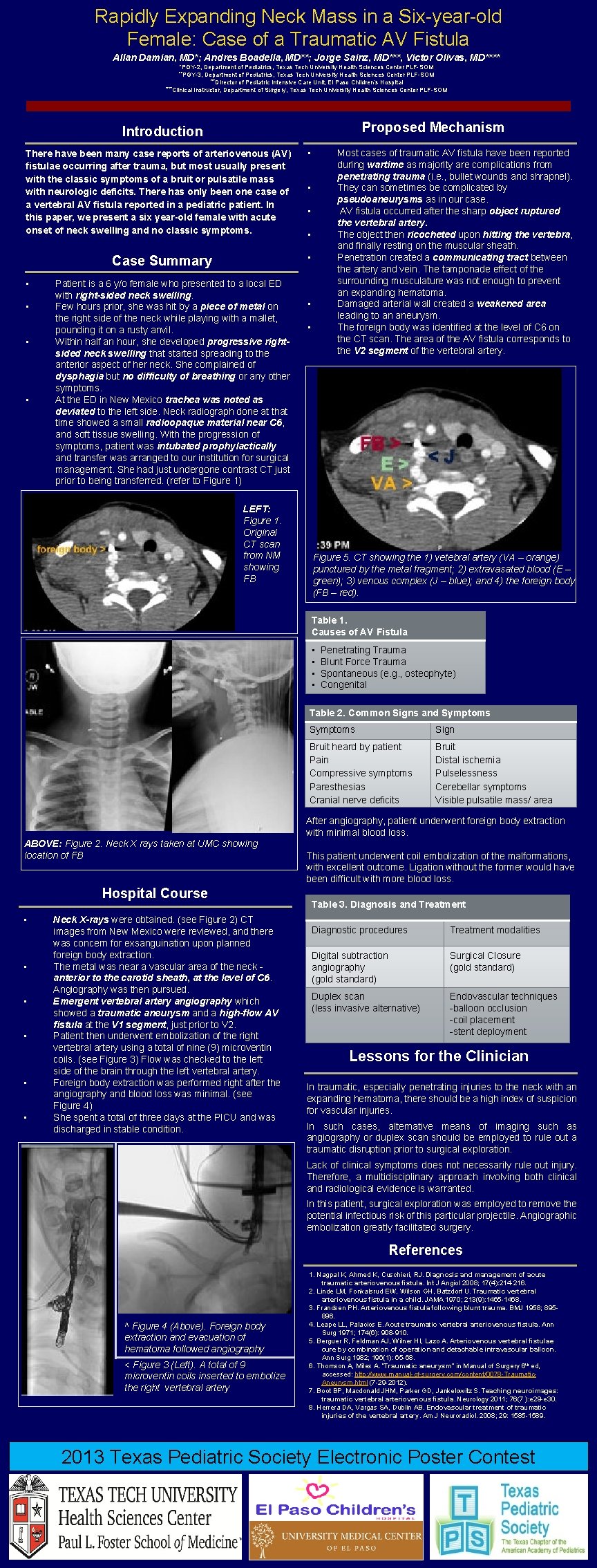 Rapidly Expanding Neck Mass in a Six-year-old Female: Case of a Traumatic AV Fistula