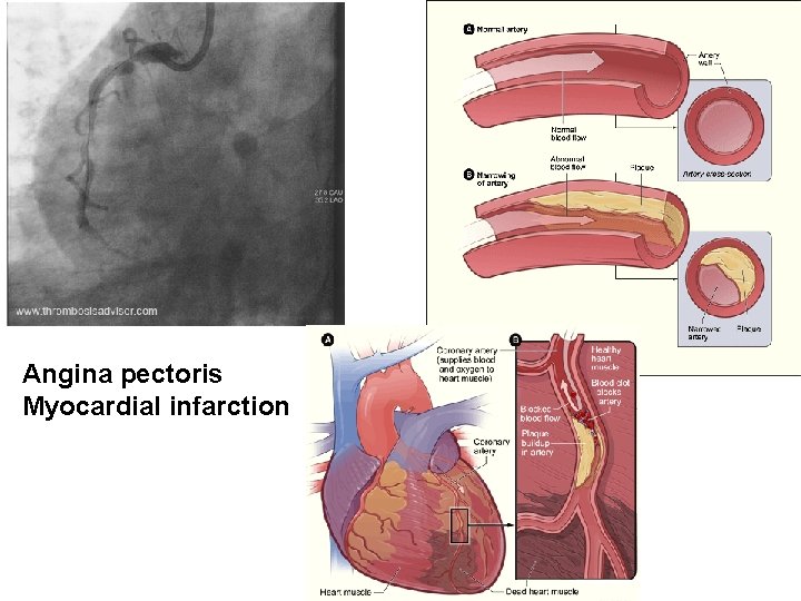 Angina pectoris Myocardial infarction 