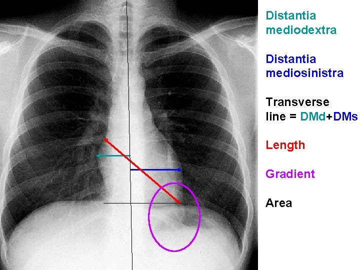 Distantia mediodextra Distantia mediosinistra Transverse line = DMd+DMs Length Gradient Area 