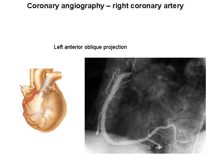 Coronary angiography – right coronary artery Left anterior oblique projection 