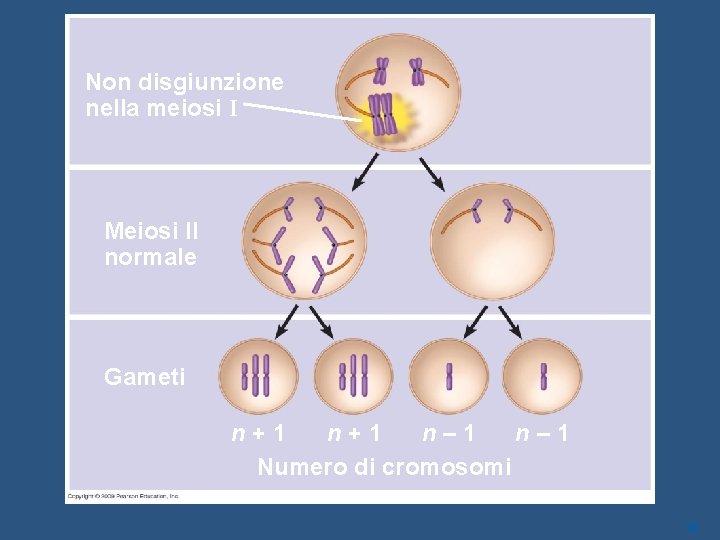 Non disgiunzione nella meiosi I Meiosi II normale Gameti n+1 n– 1 Numero di