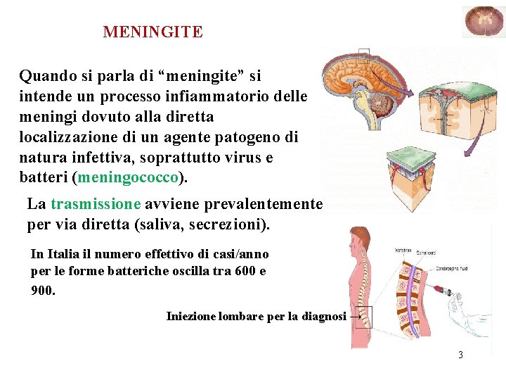 MENINGITE Quando si parla di “meningite” si intende un processo infiammatorio delle meningi dovuto