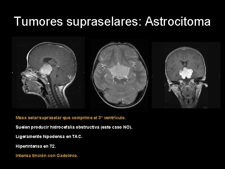 Tumores supraselares: Astrocitoma Masa selar/supraselar que comprime el 3º ventrículo. Suelen producir hidrocefalia obstructiva
