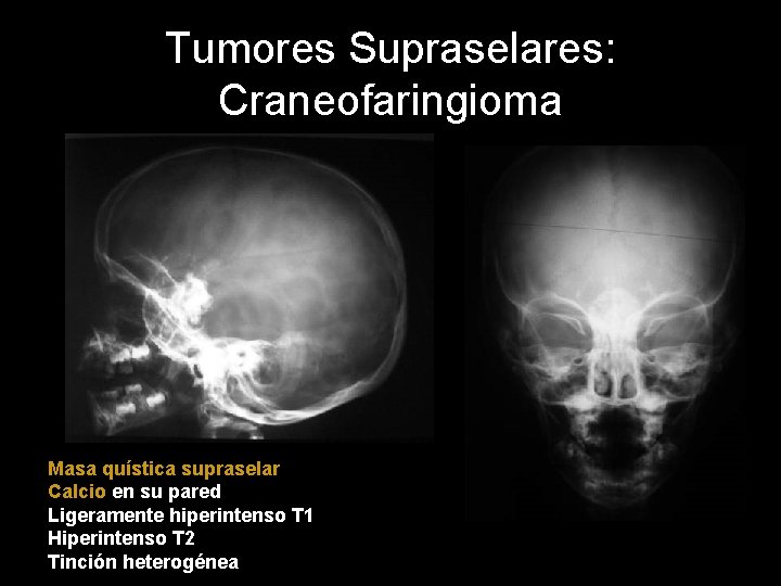 Tumores Supraselares: Craneofaringioma Masa quística supraselar Calcio en su pared Ligeramente hiperintenso T 1