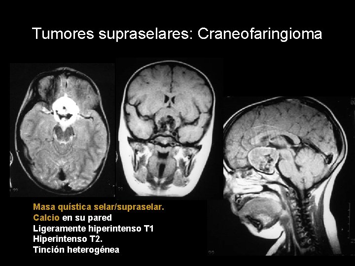 Tumores supraselares: Craneofaringioma Masa quística selar/supraselar. Calcio en su pared Ligeramente hiperintenso T 1
