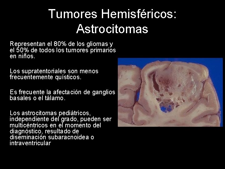 Tumores Hemisféricos: Astrocitomas Representan el 80% de los gliomas y el 50% de todos