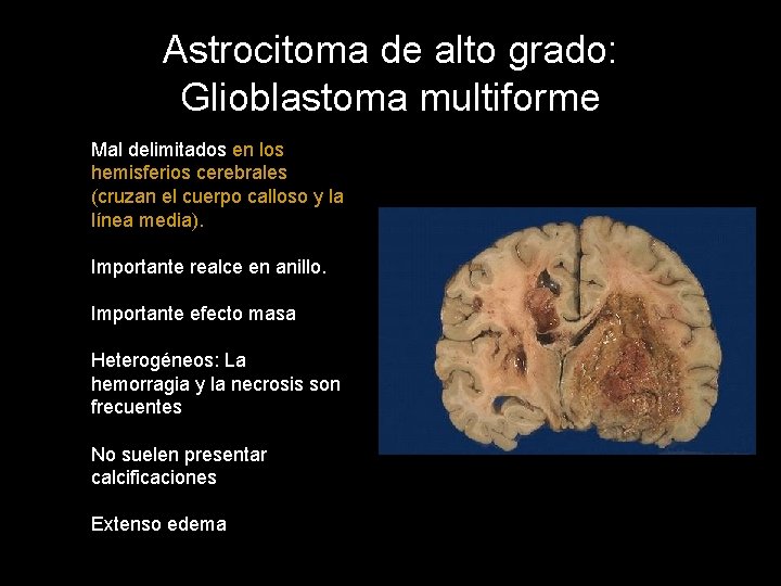 Astrocitoma de alto grado: Glioblastoma multiforme Mal delimitados en los hemisferios cerebrales (cruzan el