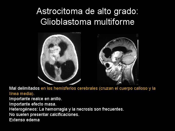 Astrocitoma de alto grado: Glioblastoma multiforme Mal delimitados en los hemisferios cerebrales (cruzan el