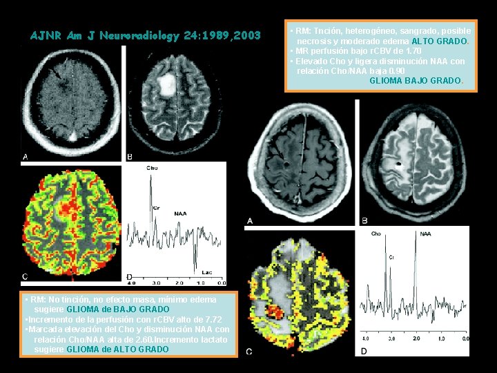 AJNR Am J Neuroradiology 24: 1989, 2003 • RM: No tinción, no efecto masa,