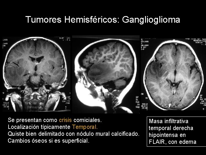 Tumores Hemisféricos: Ganglioma Se presentan como crisis comiciales. Localización típicamente Temporal. Quiste bien delimitado