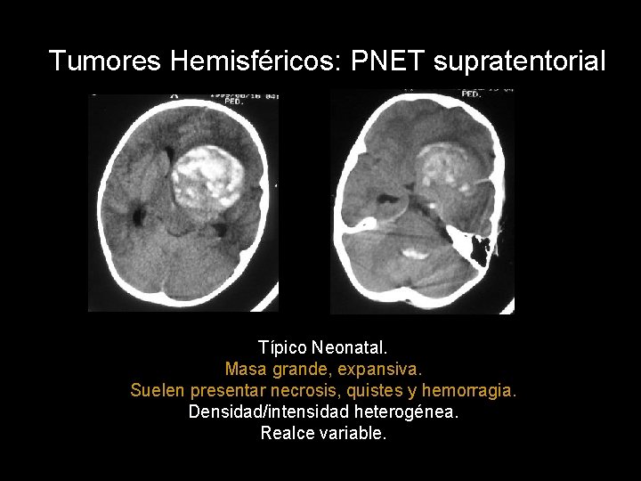 Tumores Hemisféricos: PNET supratentorial Típico Neonatal. Masa grande, expansiva. Suelen presentar necrosis, quistes y