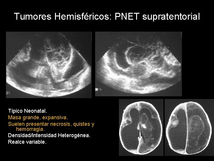 Tumores Hemisféricos: PNET supratentorial Típico Neonatal. Masa grande, expansiva. Suelen presentar necrosis, quistes y