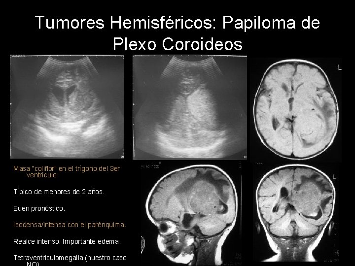 Tumores Hemisféricos: Papiloma de Plexo Coroideos Masa “coliflor” en el trígono del 3 er
