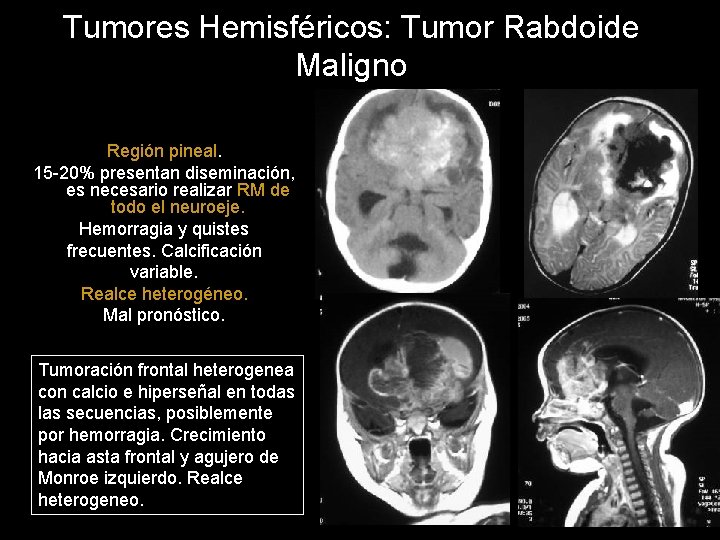 Tumores Hemisféricos: Tumor Rabdoide Maligno Región pineal. 15 -20% presentan diseminación, es necesario realizar