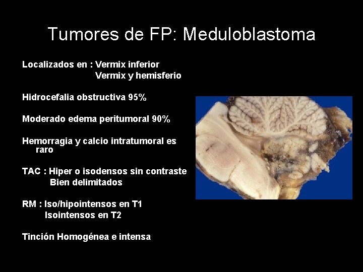 Tumores de FP: Meduloblastoma Localizados en : Vermix inferior Vermix y hemisferio Hidrocefalia obstructiva