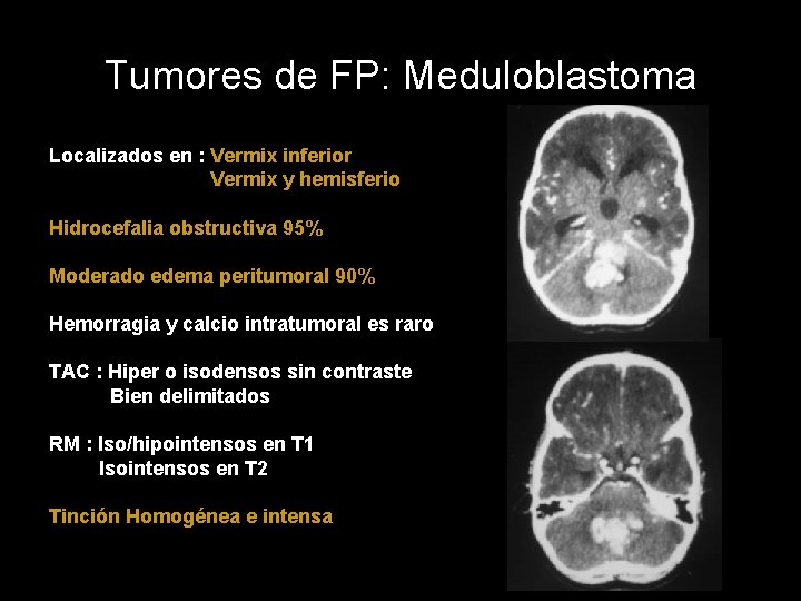 Tumores de FP: Meduloblastoma Localizados en : Vermix inferior Vermix y hemisferio Hidrocefalia obstructiva