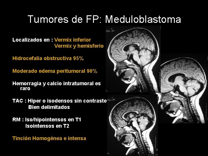 Tumores de FP: Meduloblastoma Localizados en : Vermix inferior Vermix y hemisferio Hidrocefalia obstructiva