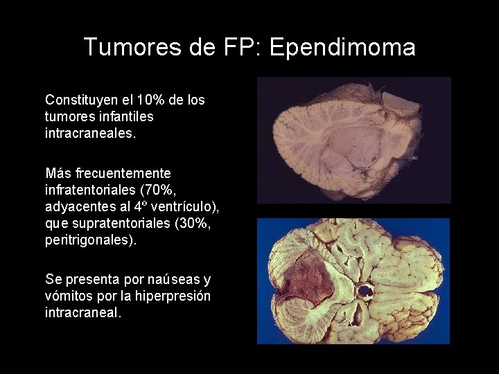 Tumores de FP: Ependimoma Constituyen el 10% de los tumores infantiles intracraneales. Más frecuentemente