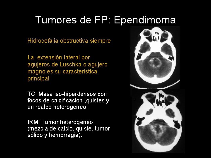 Tumores de FP: Ependimoma Hidrocefalia obstructiva siempre La extensión lateral por agujeros de Luschka