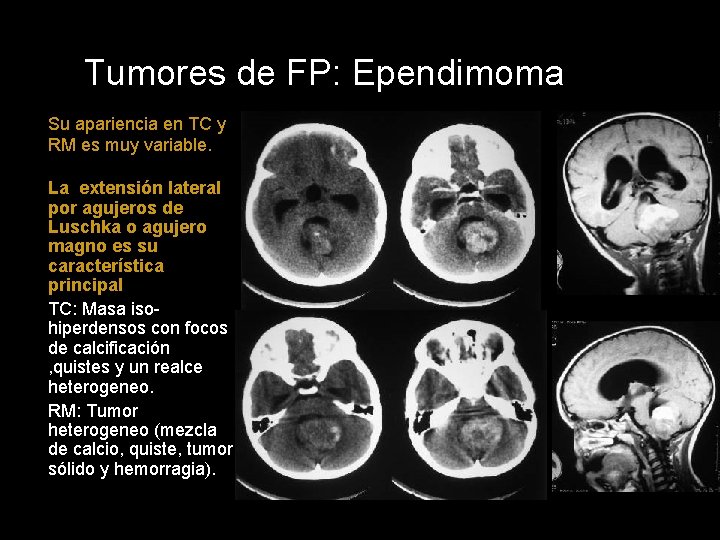 Tumores de FP: Ependimoma Su apariencia en TC y RM es muy variable. La