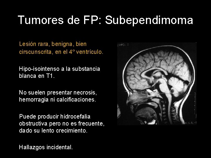 Tumores de FP: Subependimoma Lesión rara, benigna, bien cirscunscrita, en el 4º ventrículo. Hipo-isointenso