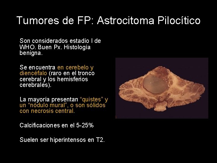 Tumores de FP: Astrocitoma Pilocítico Son considerados estadío I de WHO. Buen Px. Histología