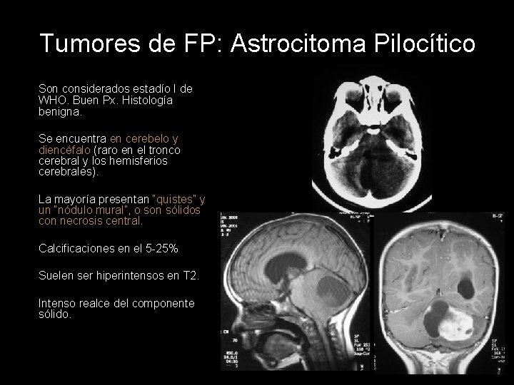 Tumores de FP: Astrocitoma Pilocítico Son considerados estadío I de WHO. Buen Px. Histología