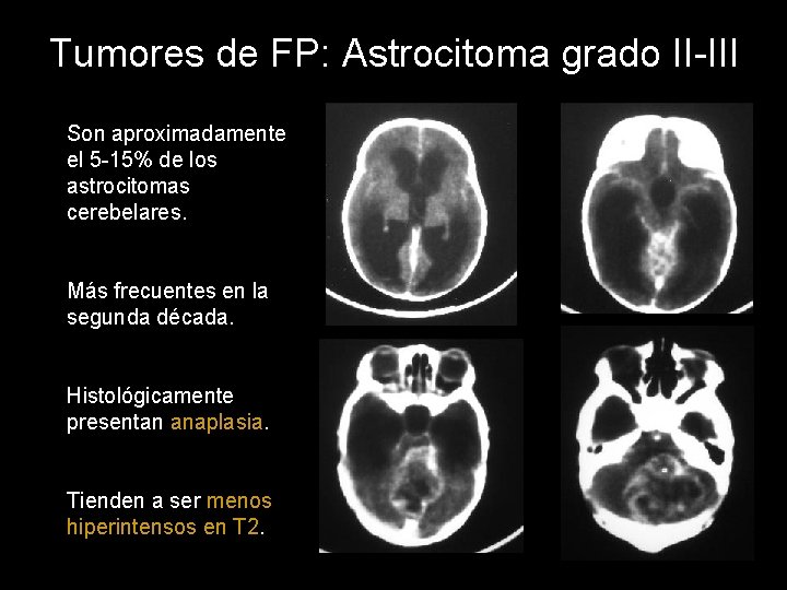 Tumores de FP: Astrocitoma grado II-III Son aproximadamente el 5 -15% de los astrocitomas
