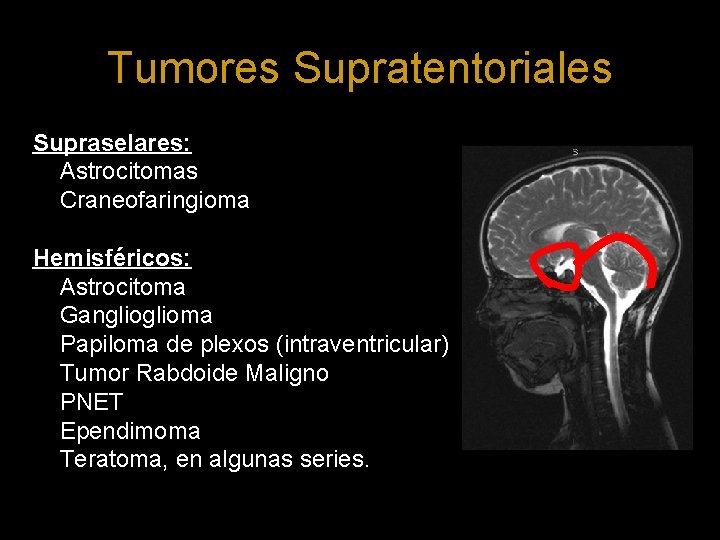 Tumores Supratentoriales Supraselares: Astrocitomas Craneofaringioma Hemisféricos: Astrocitoma Ganglioma Papiloma de plexos (intraventricular) Tumor Rabdoide