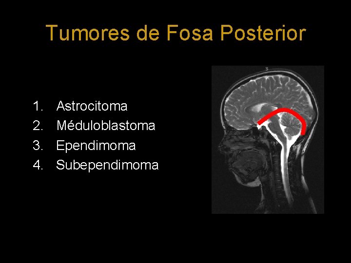 Tumores de Fosa Posterior 1. 2. 3. 4. Astrocitoma Méduloblastoma Ependimoma Subependimoma 