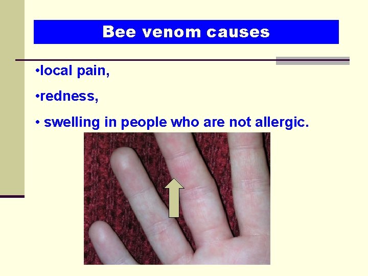 Bee venom causes • local pain, • redness, • swelling in people who are Bee venom causes • local pain, • redness, • swelling in people who are