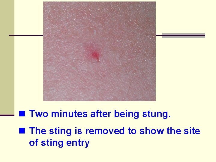 n Two minutes after being stung. n The sting is removed to show the