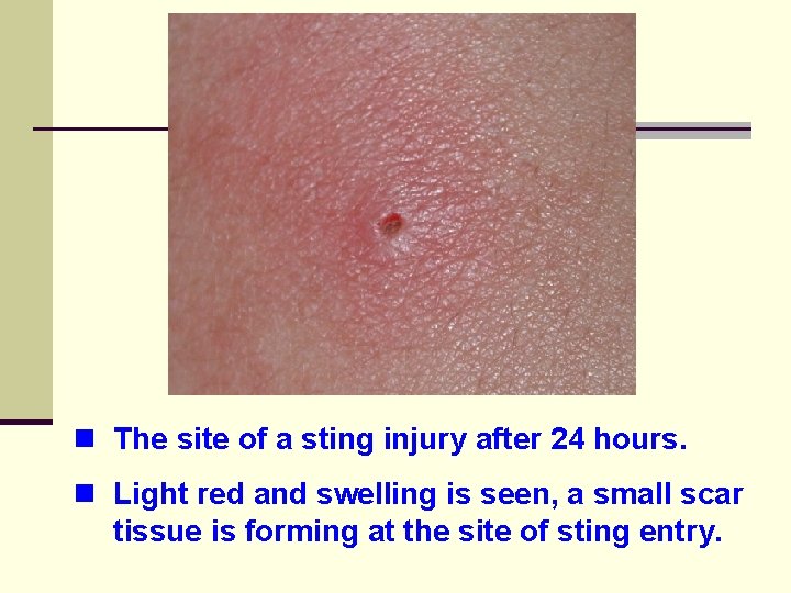 n The site of a sting injury after 24 hours. n Light red and