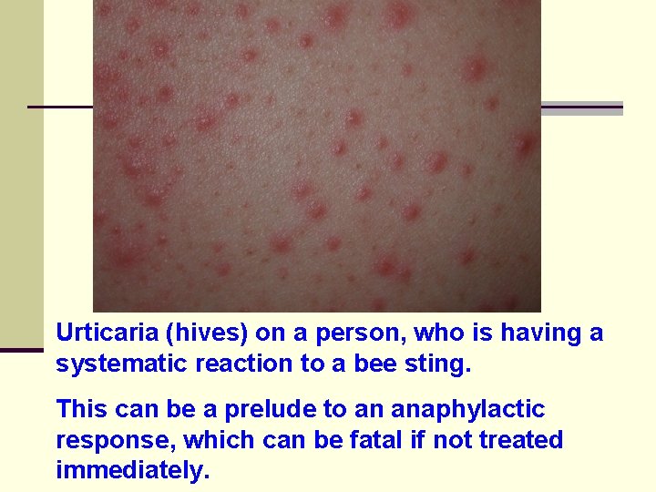 Urticaria (hives) on a person, who is having a systematic reaction to a bee