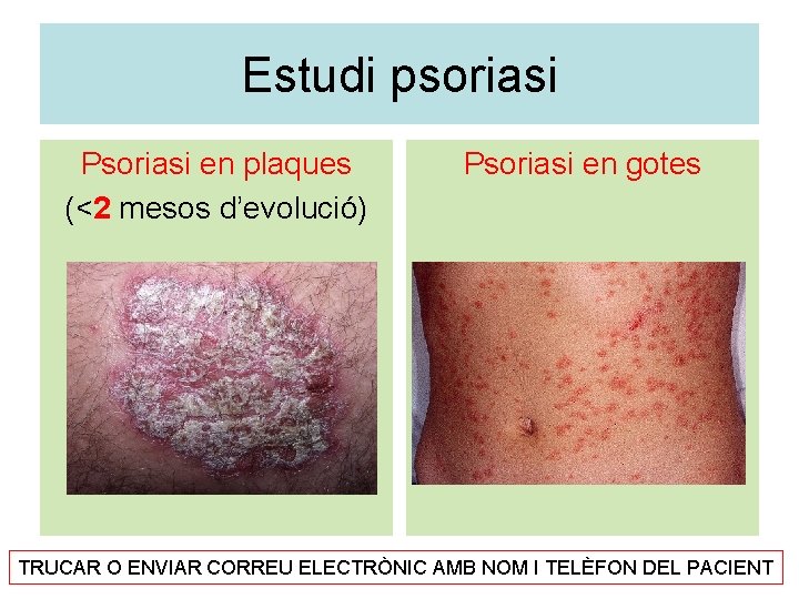 Estudi psoriasi Psoriasi en plaques (<2 mesos d’evolució) Psoriasi en gotes TRUCAR O ENVIAR