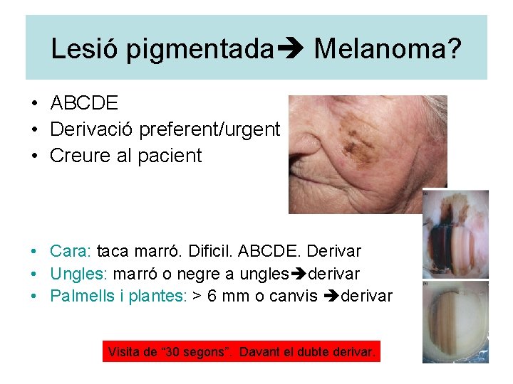 Lesió pigmentada Melanoma? • ABCDE • Derivació preferent/urgent • Creure al pacient • Cara: