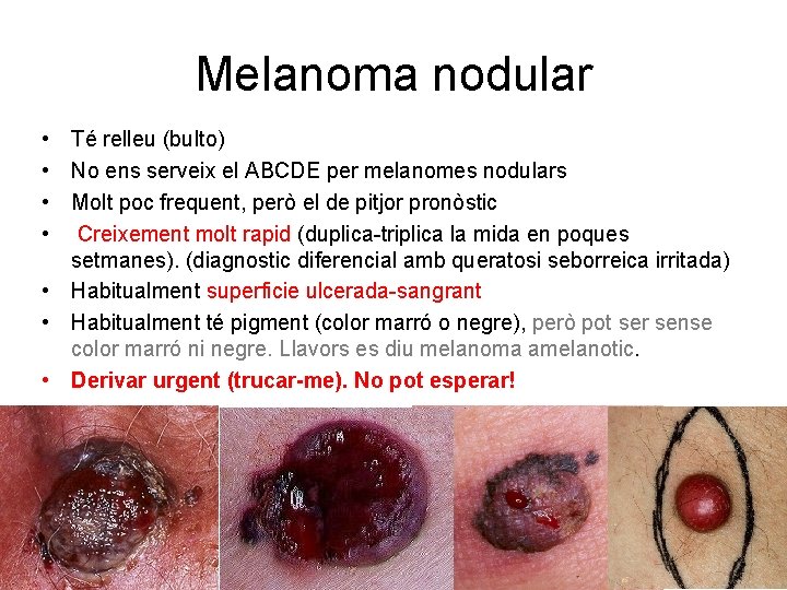 Melanoma nodular • Té relleu (bulto) • No ens serveix el ABCDE per melanomes